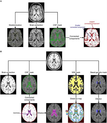 Segmentation of incident lacunes during the course of ischemic cerebral small vessel diseases